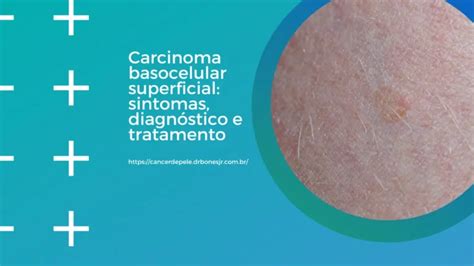 Carcinoma Basocelular Especialista Em Câncer De Pele