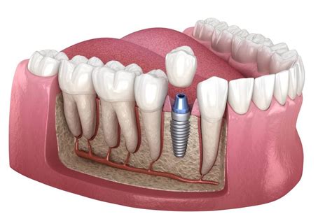 Dental Implant Healing Stages