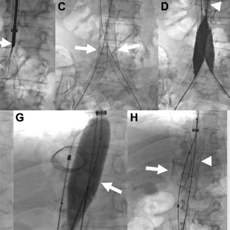 Pdf Management And Treatment Of Iliocaval Thrombosis Using