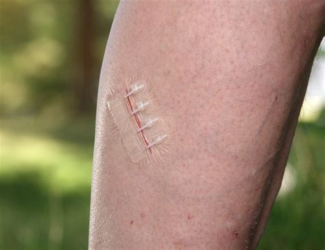 ZipStitch Is a Wound Closure Device that Works in Seconds