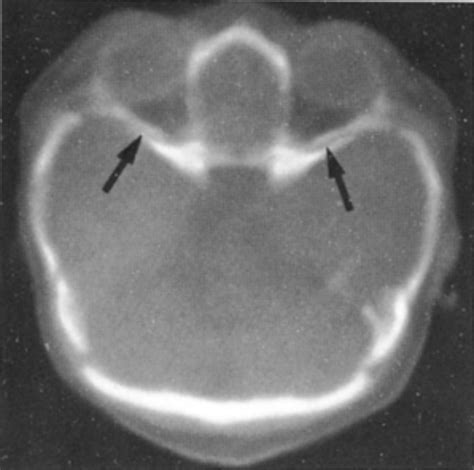 Computerized Tomography Of Cranial Sutures In Journal Of Neurosurgery