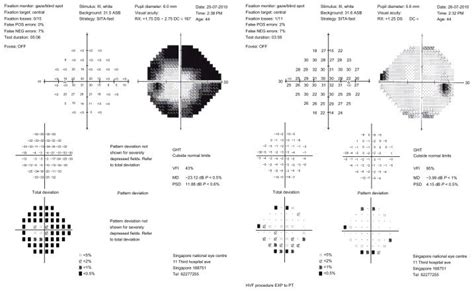 Humphrey Visual Field Sita Fast Protocol Of Patients Right And