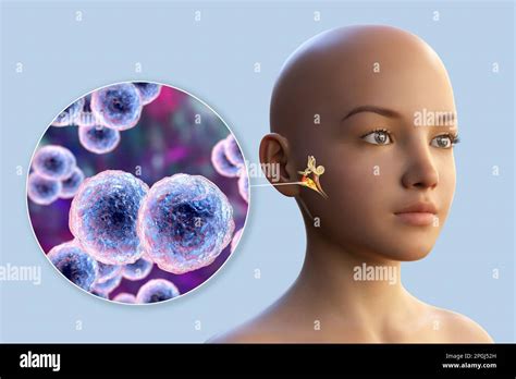 Otitis Media Infección Del Oído Causada Por La Bacteria Moraxella