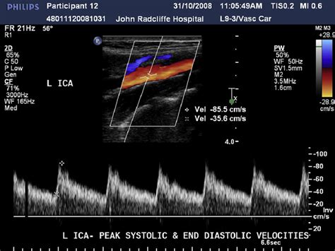duplex ultrasound image  spectrogram   left ica cursor markers