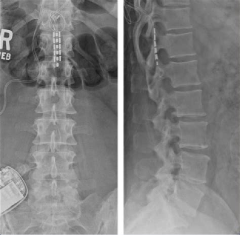 Plain Ap And Lateral Radiographs Of Spinal Cord Stimulator Implant In