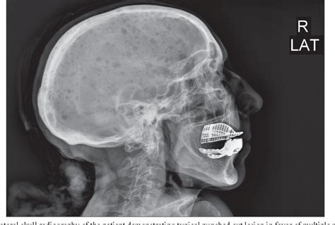 Figure 1 From Diffuse Punched Out Lesions In Multiple Myeloma Semantic Scholar