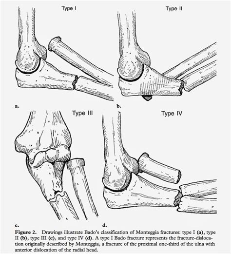 孟氏骨折monteggia Fracture 小小整理網站 Smallcollation