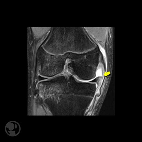 Anatom A Y Biomec Nica De Las Lesiones De Las Estructuras Ligamentosas