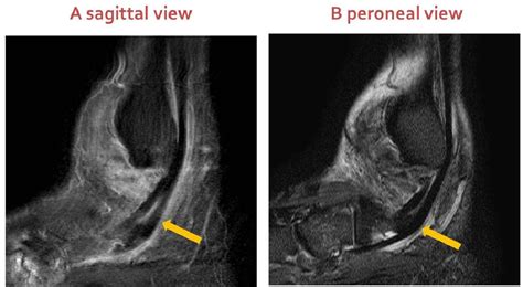 Figure 2 from Peroneal tendon pathology evaluation using the oblique ...