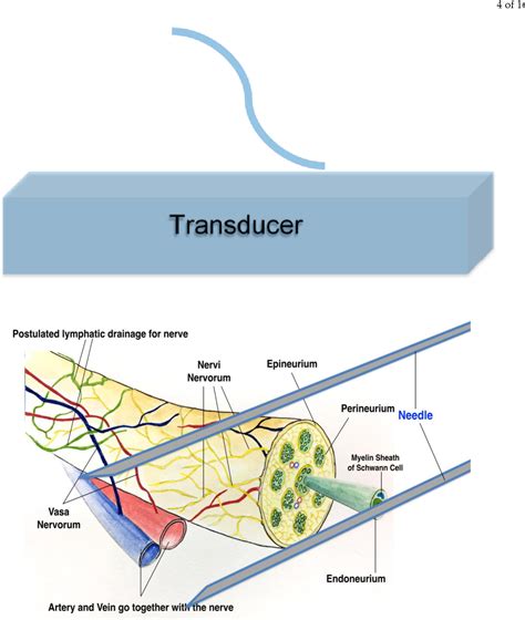 Figure 2 From Ultrasound Guided Nerve Hydrodissection For Pain Management An Updated Review Of