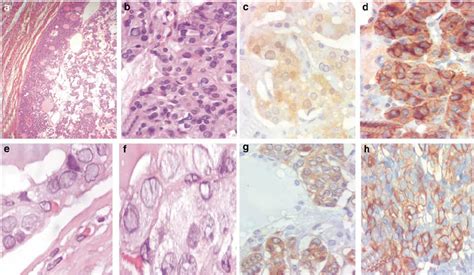 Well Differentiated Tumors Of Uncertain Malignant Potential WDT UMP