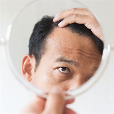 DHT And Hair Loss What You Need To Know Ro