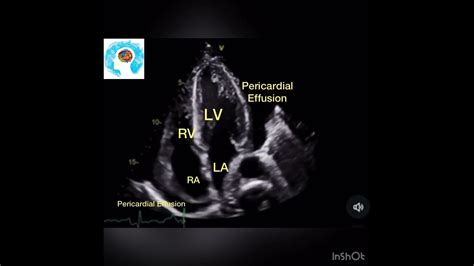 Pericardial Effusion On Cardiac Ultrasound 4 Chambers View Cardio