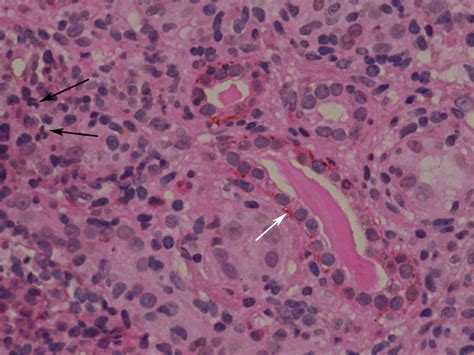 C5a And Its Receptors In Human Anti Neutrophil Cytoplasmic Antibody