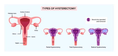 Hysterectomy Diagram Hysterectomy Complications Infographic