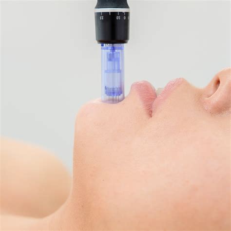 Microneedling Dermapen Stockholm Cosmian Beauty Clinic