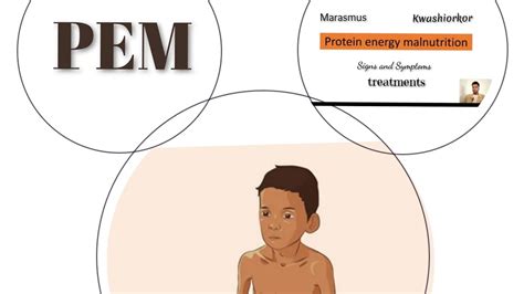 protein energy malnutrition pem marasmus kwashiorkor mixed