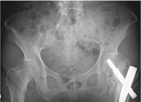 Anteroposterior Pelvis Radiograph Download Scientific Diagram