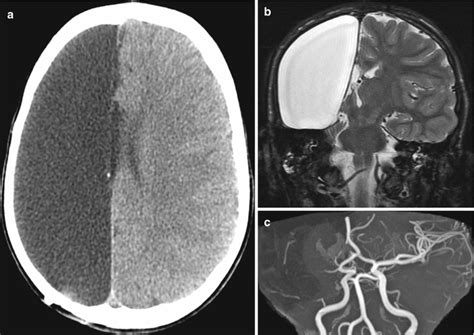 Imaging The Intraoperative And Postoperative Brain Radiology Key