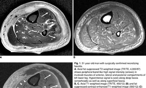 Figure 1 From Necrotizing Fasciitis Versus Pyomyositis Discrimination