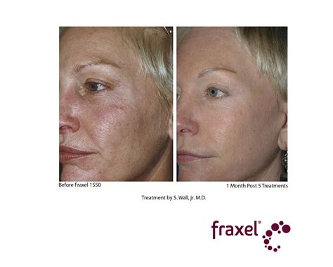 Fraxel Laser Treatment Cost Results Studiomd Midtown Manhattan Nyc