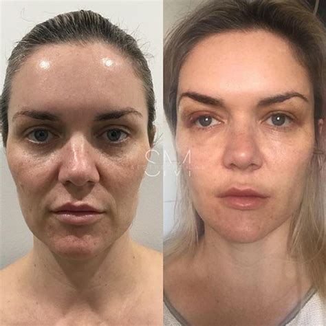 Aptos Thread Lifts Pdo Threads Non Surgical Facelift In Sydney