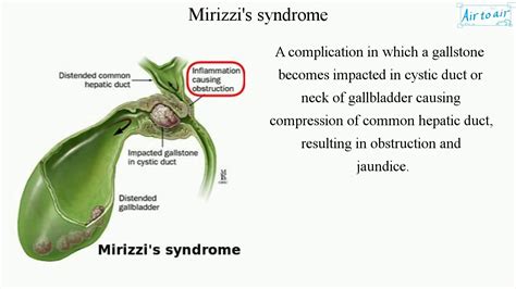 Mirizzi Syndrome: Diagnosis, Treatment, Symptoms,, 47% OFF