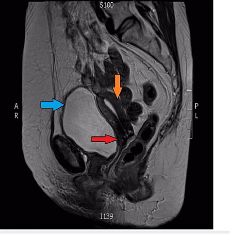 Sagittal View From Mri Scan Blue Arrow Bladder Orange Arrow Fundus