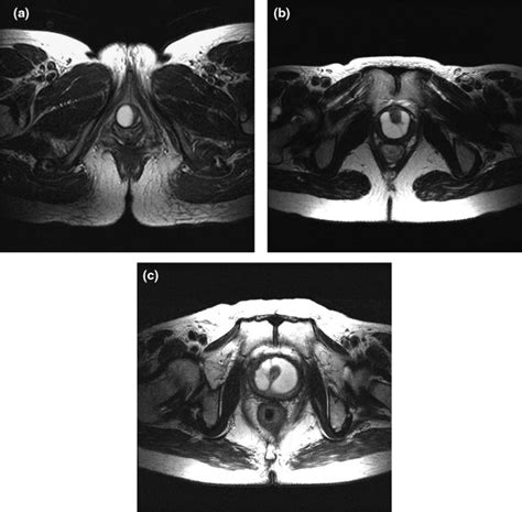 Outcomes Of Surgery Of Female Urethral Diverticula Classified Using