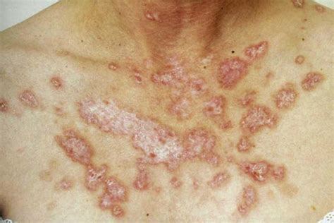 Cleveland Clinic Dermatologic Signs Of Systemic Disease Virtual