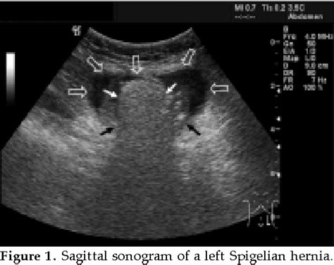 Abdominal Hernia Ultrasound