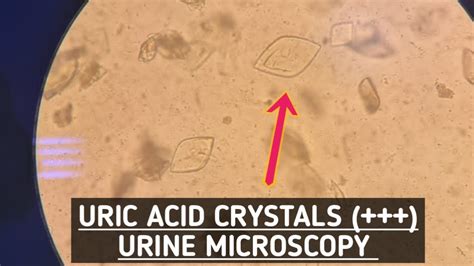 Uric Acid Crystals Seen In Urine Microscopyurine Routine