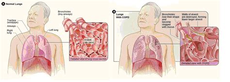 What Do Copd Lungs Look Like