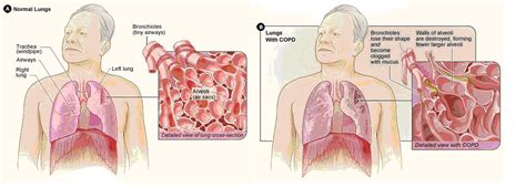 Copd Lungs Critical Care Practitioner