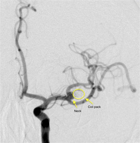 Surgical Clipping Of Recurrent Previously Coiled Mca Bifurcation