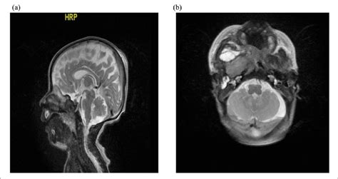 A And B Magnetic Resonant Imaging On Head And Neck Showing Right