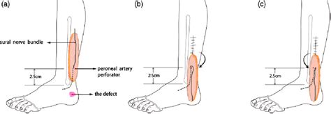 Diagram Of Different Rotation Directions Of The 25 Cm Double Pedicle