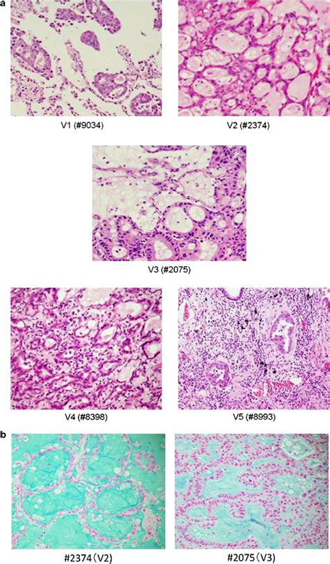 Eml4 Alk Lung Cancers Are Characterized By Rare Other Mutations A Ttf