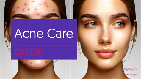 Navigating The Landscape Of Acne A Comprehensive Guide To Effective