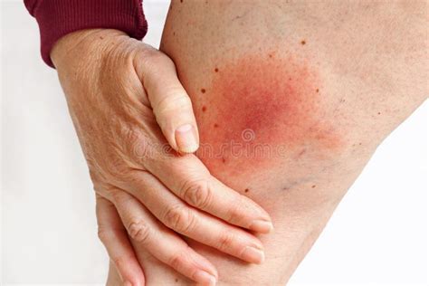 Lyme Borreliosis From A Tick Bite Stock Photo Image Of Area Tick