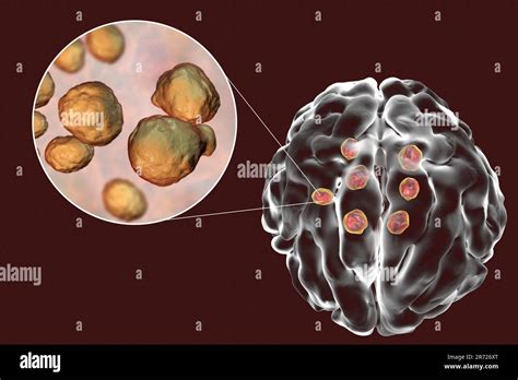 Multiple brain parenchyma lesions caused by fungus Cryptococcus neoformans, illustration. C ...