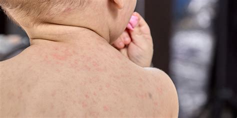 Allergico Colloquio Materno Antibiotico Per Scarlattina Bimbi Magro