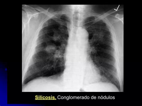 Interpretaci N Radiograf A T Rax Oit Neumoconiosis Dr Casanova Ppt