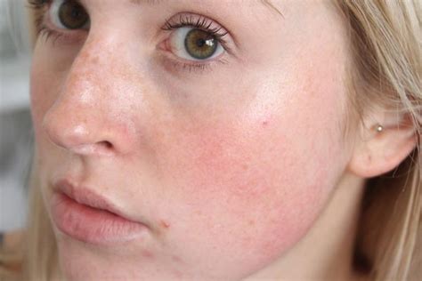 Facial Rashes Due To Rheumatoid Arthritis Naked Images