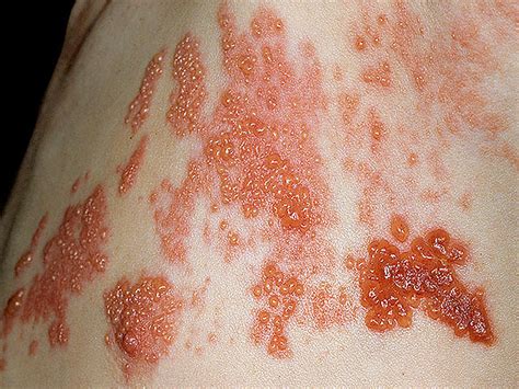 Is It Shingles Myths About Painful Illness Graphic Images Photo