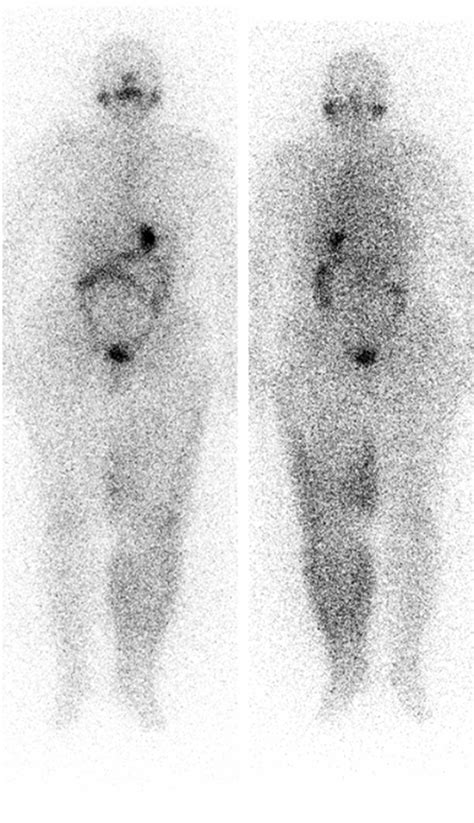 Radioactive Iodine Scan