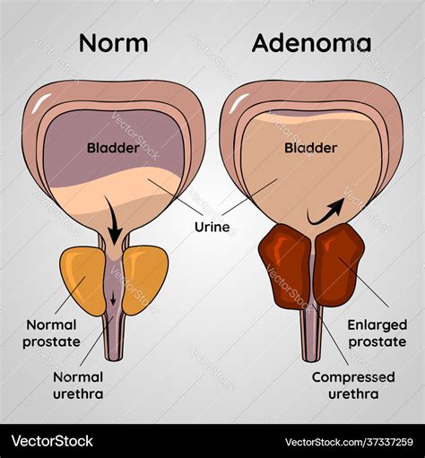 Normal Bladder And Bph Problem Prostate Adenoma Vector Image