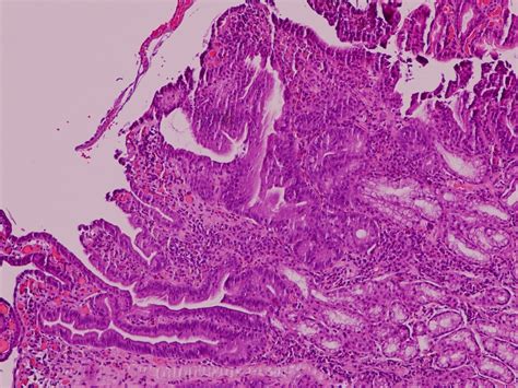 Pathology Outlines Russell Body Gastritis