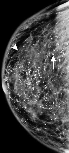 Male Breast Disease Pictorial Review With Radiologic Pathologic