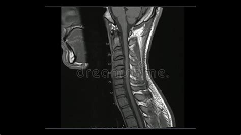 Magnetic Resonance Images Of Cervical Spine Sagittal T Weighted Images